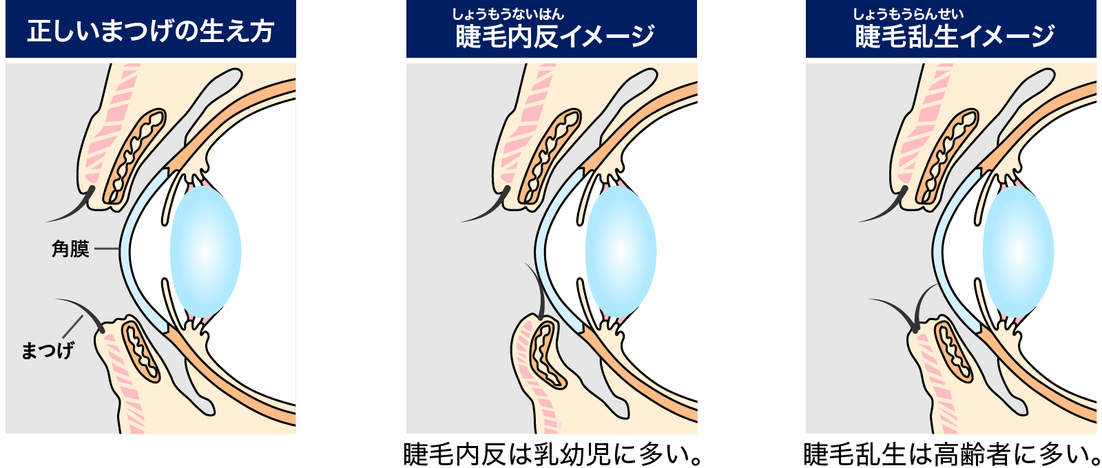 眼瞼内反症の原因