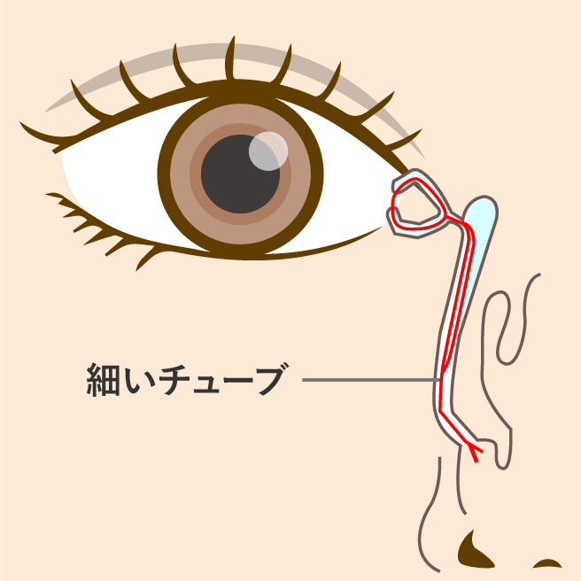 涙道チューブ挿入術