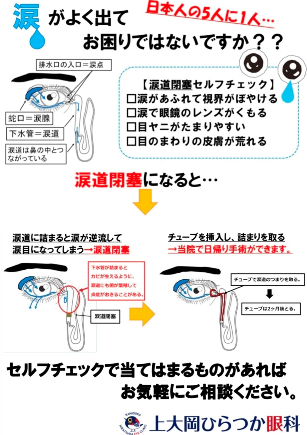 涙管チューブ挿入術