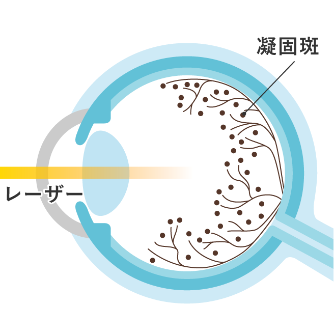 レーザー光凝固術