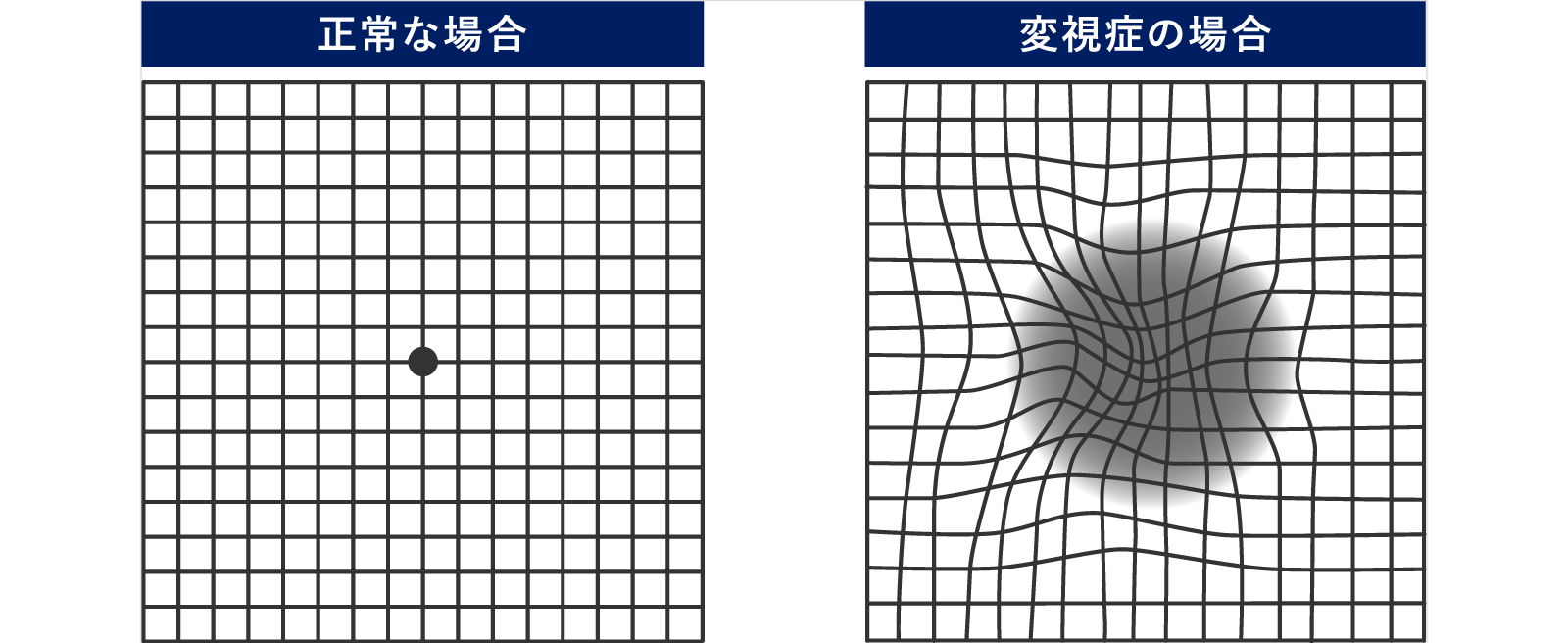 加齢⻩斑変性の検査