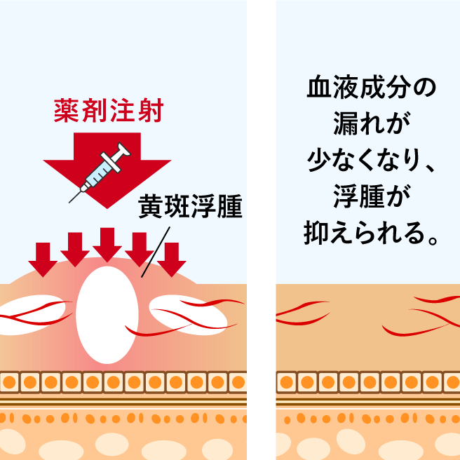 黄斑浮腫（糖尿病網膜症、網膜静脈分枝閉塞症、網膜中心静脈閉塞症に伴う）