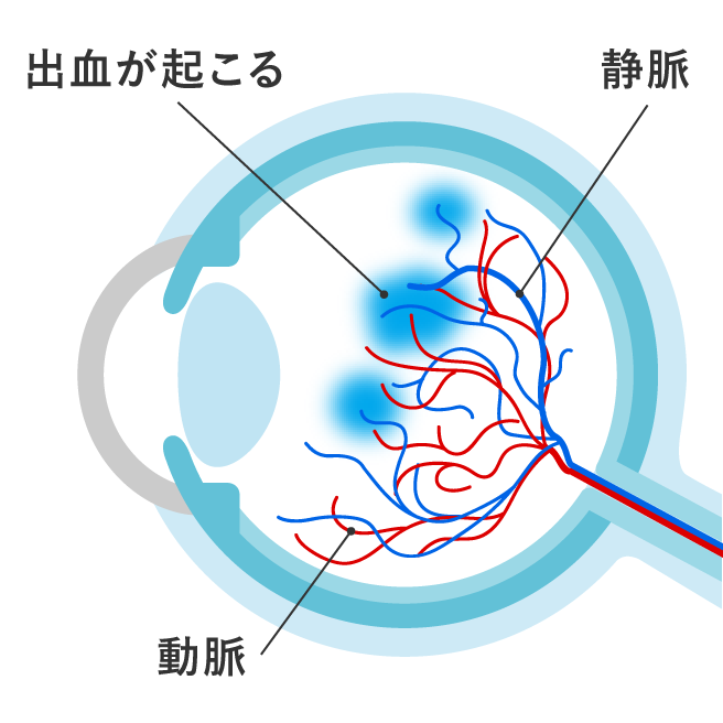 網膜静脈閉塞症