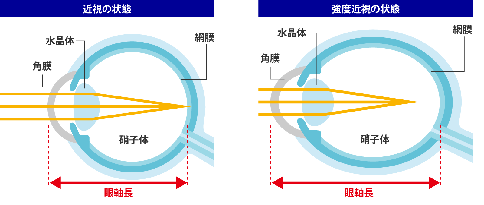 なぜ近視の進行を抑制することが大切なのでしょうか