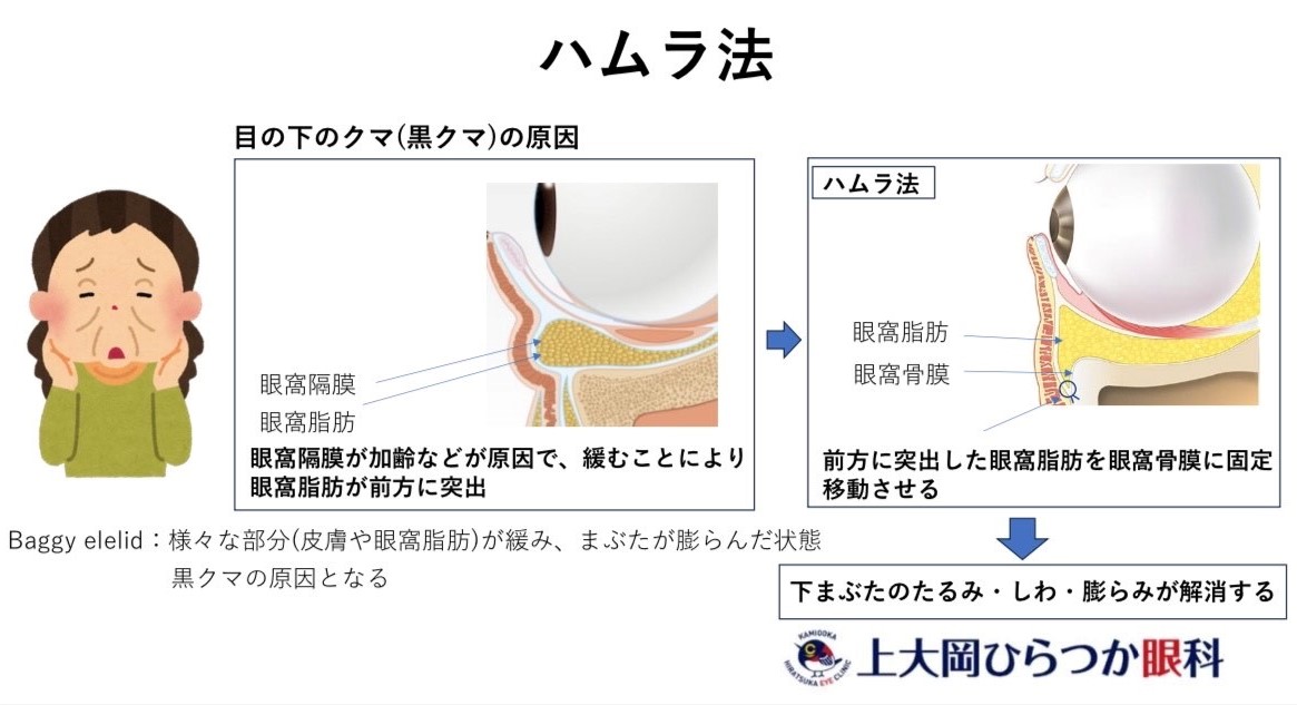 ハムラ法