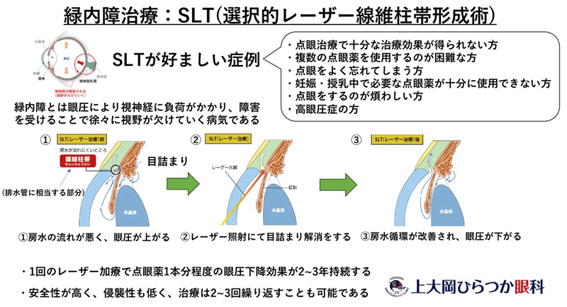 隅角光凝固術（SLT：選択的レーザー線維柱帯形成術）